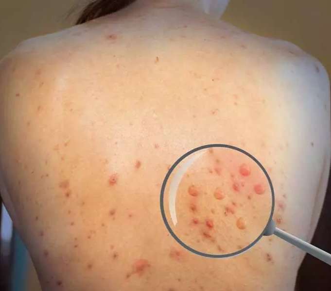¿Qué significa esta emergencia de salud?